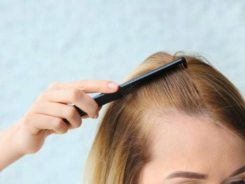 Calvície Feminina: Como Identificar e Tratar a Queda de Cabelo em Mulheres