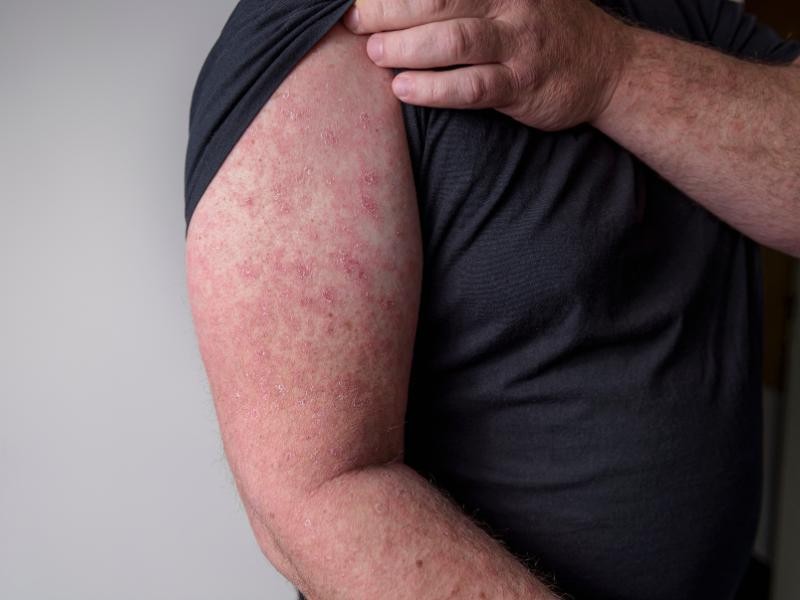 O que é Erisipela? Saiba mais Sobre essa Infecção na Pele