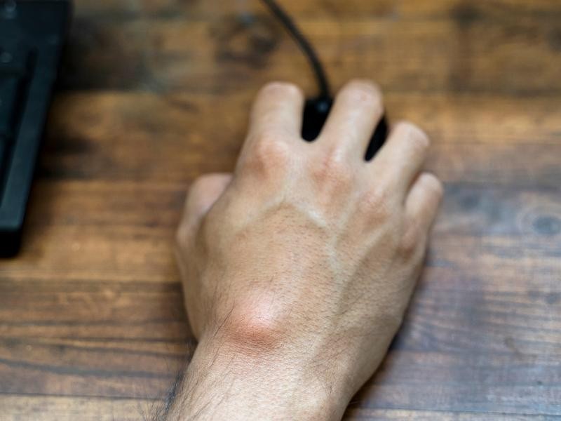 Cisto Sinovial: Quando o “carocinho” no Punho Precisa de Avaliação