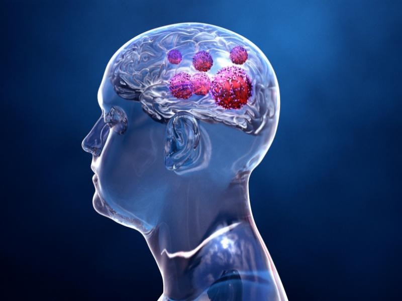 TUMOR CEREBRAL: ENTENDA OS RISCOS DE UM TUMOR CEREBRAL