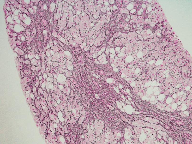 ESTEATOSE HEPÁTICA: VEJA AQUI OS RISCOS DA ESTEATOSE HEPÁTICA, OS TRATAMENTOS PARA A ESTEATOSE HEPÁTICA E ETC...