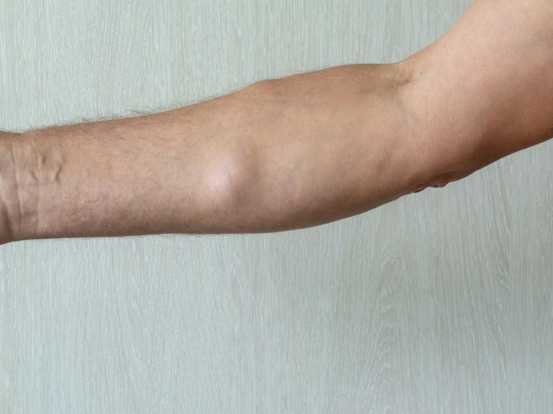 Bolinhas Sob a Pele no Braço Podem Ser Lipomas? Descubra os Sinais e Tratamentos