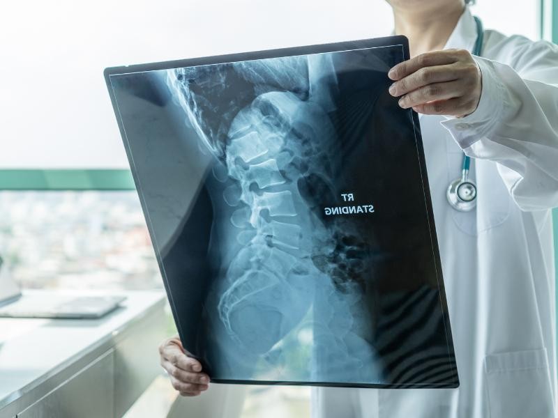 Atrofia Muscular Espinhal (AME): O que é, Tipos, Sintomas e Terapias Disponíveis