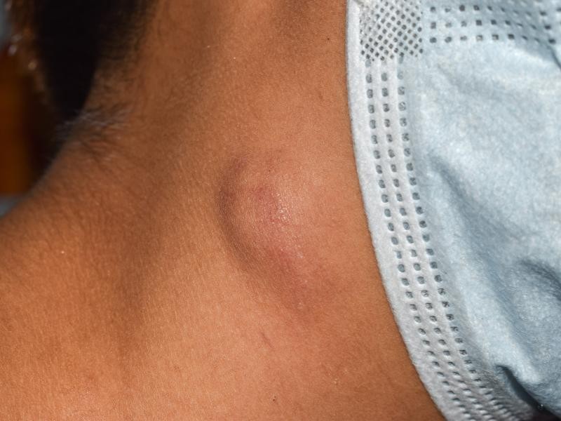 Linfonodos Inchados: Causas, Sintomas e Quando Investigar os Gânglios Linfáticos