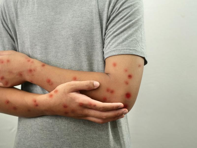 Mpox: Entenda a Doença, Exames e Principais Tratamentos