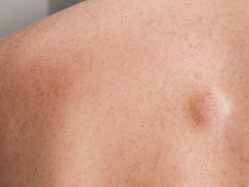 Bolinhas Sob a Pele no Braço Podem Ser Lipomas? Descubra os Sinais e Tratamentos
