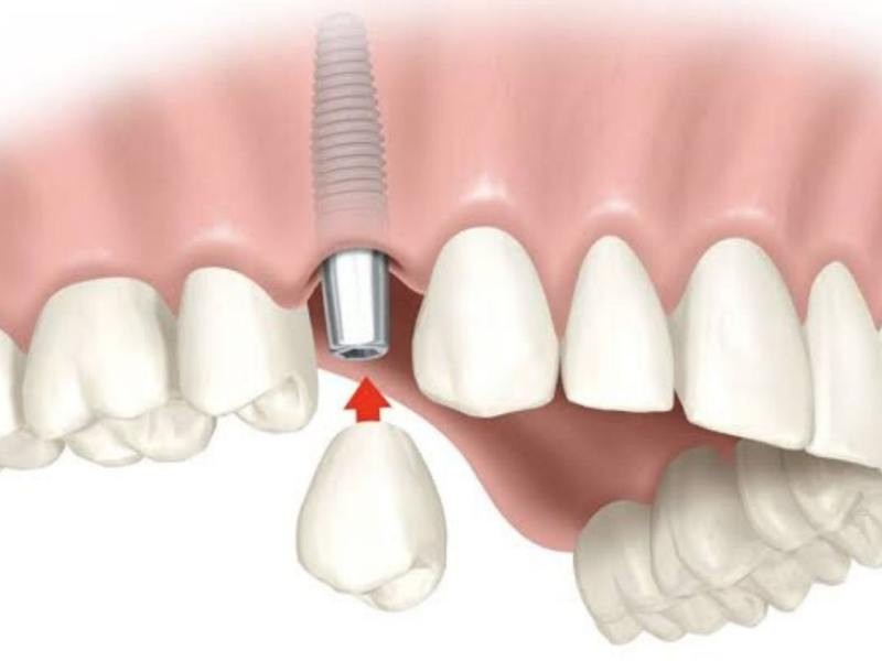 IMPLANTES DENTÁRIOS