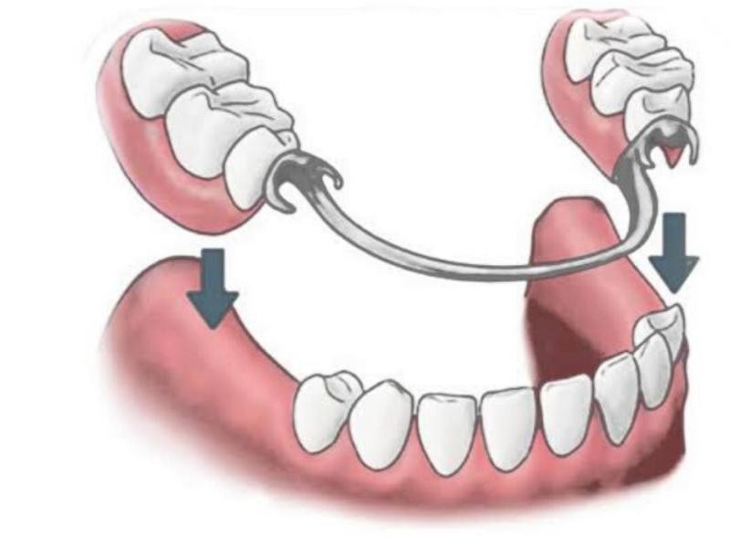 PRÓTESES DENTÁRIAS